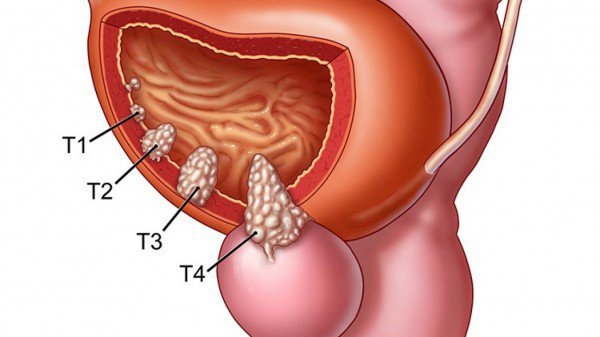 Ung thư bàng quang: Nguyên nhân, triệu chứng, chẩn đoán và điều trị