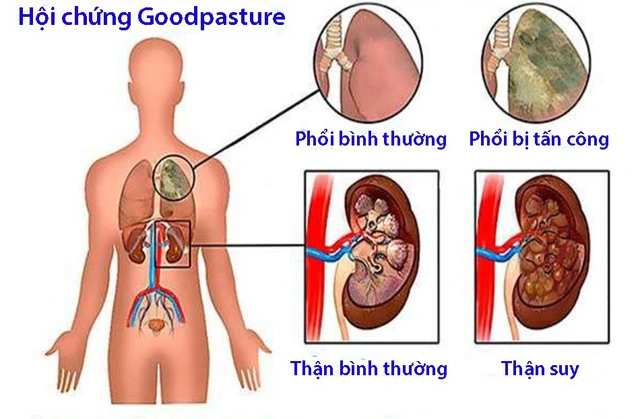 Hội chứng Goodpasture: Nguyên nhân, triệu chứng, chẩn đoán và điều trị