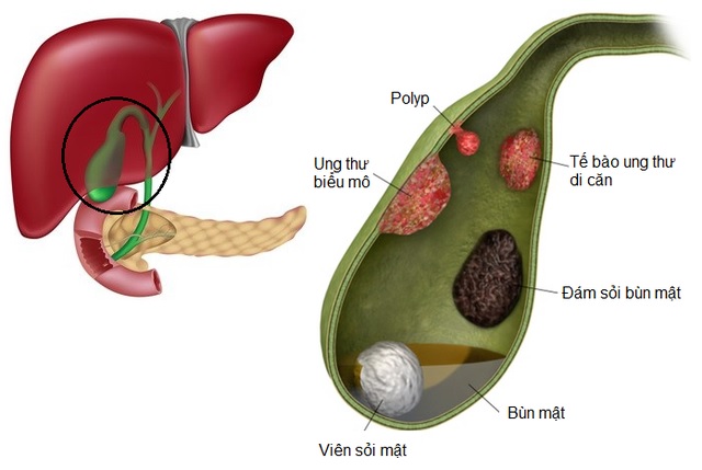 Polyp túi mật: Nguyên nhân, triệu chứng, chẩn đoán và điều trị