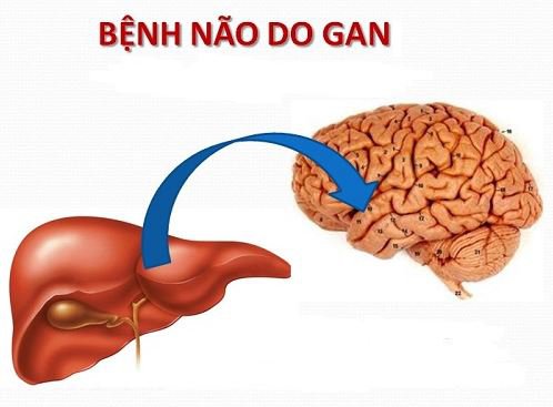 Não gan (hôn mê gan): Nguyên nhân, triệu chứng, chẩn đoán và điều trị