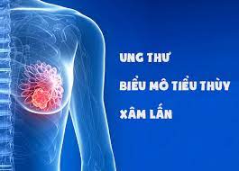 Ung thư biểu mô tiểu thùy xâm lấn: Nguyên nhân, triệu chứng, chẩn đoán và điều trị