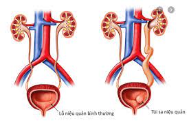 Niệu quản giãn: Nguyên nhân, triệu chứng, chẩn đoán và điều trị