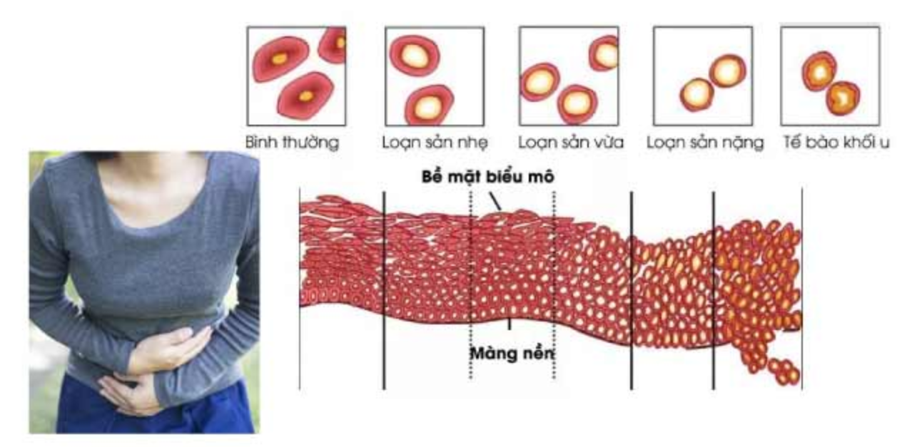 Loạn sản cổ tử cung: Nguyên nhân, triệu chứng, chẩn đoán và điều trị