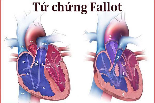 Tứ chứng Fallot: Nguyên nhân, triệu chứng, chẩn đoán và điều trị