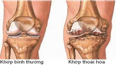 Thoái hóa khớp gối: Nguyên nhân, triệu chứng, chẩn đoán và điều trị