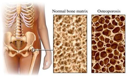 Loãng xương: Nguyên nhân, triệu chứng, chẩn đoán và điều trị