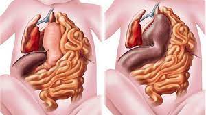 Thoát vị hoành ở trẻ em: Nguyên nhân, triệu chứng, chẩn đoán và điều trị