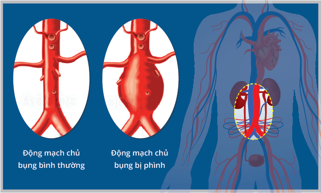 Phình động mạch chủ: Nguyên nhân, triệu chứng, chẩn đoán và điều trị