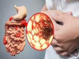 Crohn. Nguyên nhân, triệu chứng, chẩn đoán và điều trị