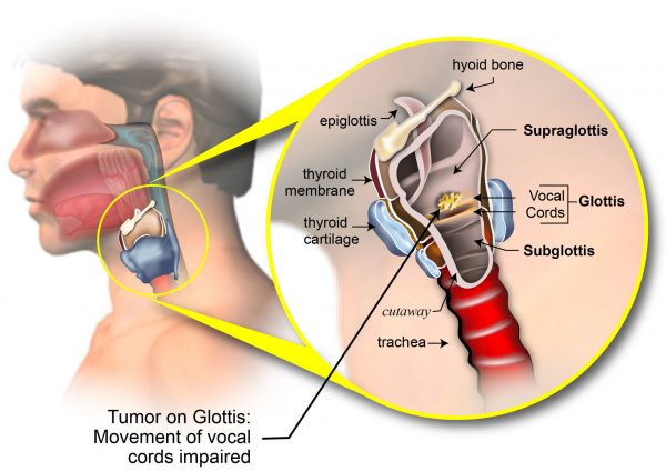 Ung thư thanh quản: Nguyên nhân, triệu chứng, chẩn đoán và điều trị