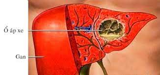 Áp xe gan do amip. Nguyên nhân, triệu chứng, chẩn đoán và điều trị