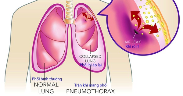 Tràn khí màng phổi tự phát: Nguyên nhân, triệu chứng, chẩn đoán và điều trị