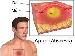 Áp xe. Nguyên nhân, triệu chứng, chẩn đoán và điều trị