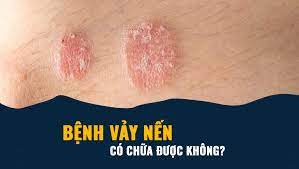 Bệnh vảy nến. Nguyên nhân, triệu chứng, chẩn đoán và điều trị