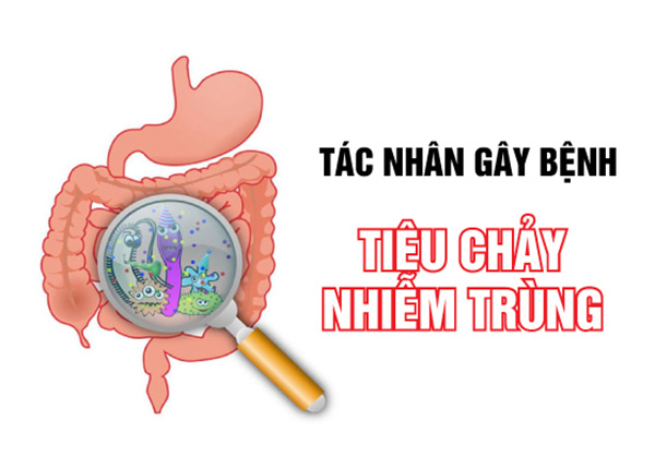 Tiêu chảy nhiễm trùng: Nguyên nhân, triệu chứng, chẩn đoán và điều trị