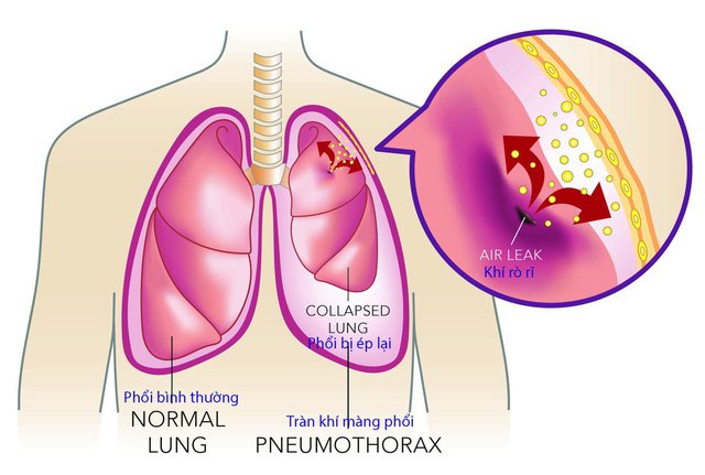 Tràn dịch màng phổi: Nguyên nhân, triệu chứng, chẩn đoán và điều trị