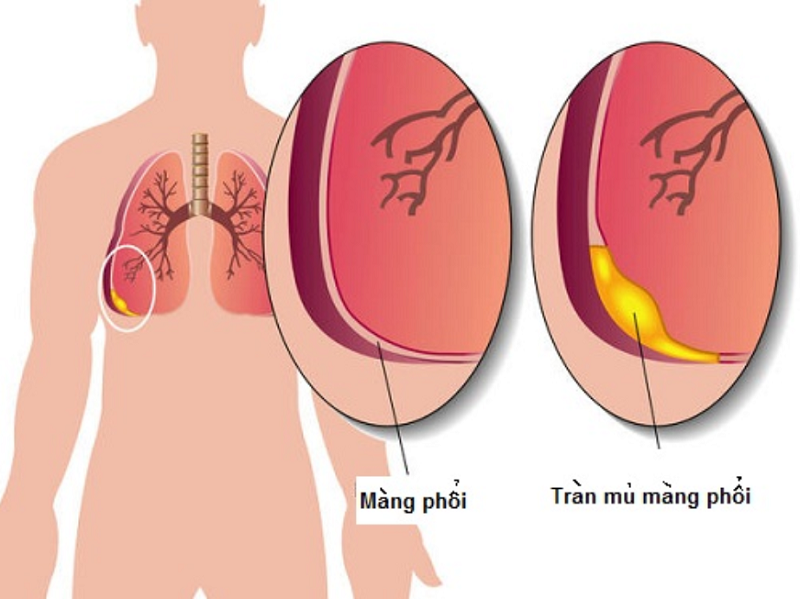 Lao màng phổi: Nguyên nhân, triệu chứng, chẩn đoán và điều trị