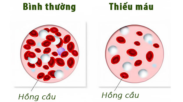 Thiếu máu do thiếu sắt: Nguyên nhân, triệu chứng, chẩn đoán và điều trị