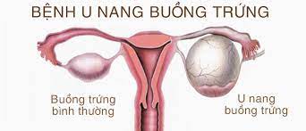 U nang buồng trứng: Nguyên nhân, triệu chứng, chẩn đoán và điều trị