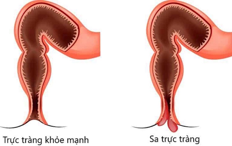 Sa trực tràng: Nguyên nhân, triệu chứng, chẩn đoán và điều trị