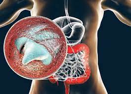 Bệnh do Cryptosporidium. Nguyên nhân, triệu chứng, chẩn đoán và điều trị