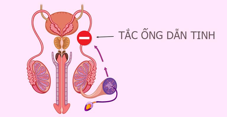 Tắc ống phóng tinh: Nguyên nhân, triệu chứng, chẩn đoán và điều trị