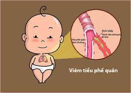 Viêm tiểu phế quản: Nguyên nhân, triệu chứng, chẩn đoán và điều trị