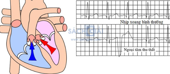 Ngoại tâm thu (ngoại tâm thu thất): Nguyên nhân, triệu chứng, chẩn đoán và điều trị