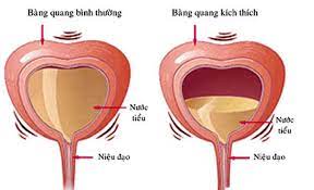 Bàng quang tăng hoạt.  Nguyên nhân, triệu chứng, chẩn đoán và điều trị