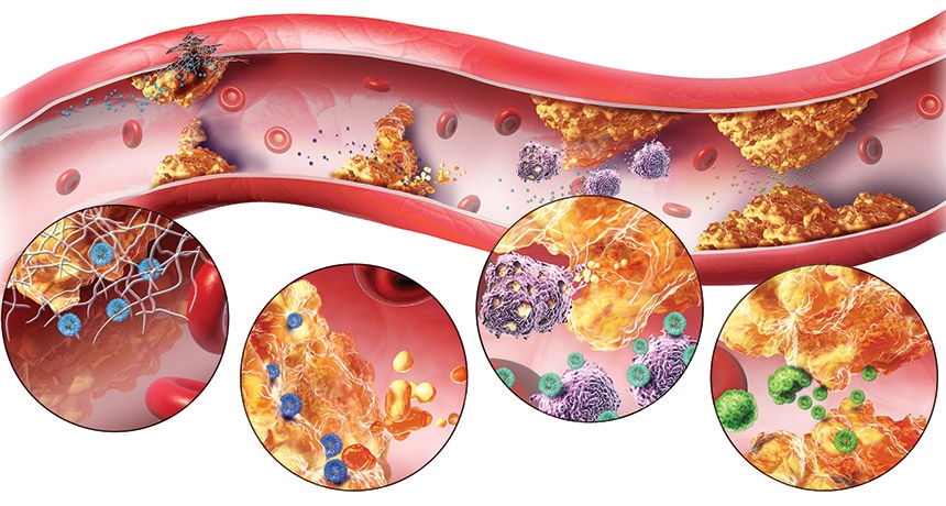 Rối loạn lipid máu: Nguyên nhân, triệu chứng, chẩn đoán và điều trị