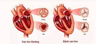 Hẹp van hai lá: Nguyên nhân, triệu chứng, chẩn đoán và điều trị