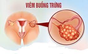 Viêm buồng trứng: Nguyên nhân, triệu chứng, chẩn đoán và điều trị