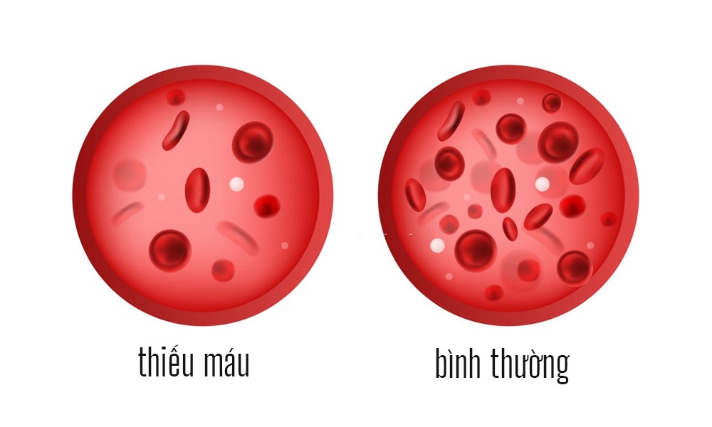 Thiếu máu: Nguyên nhân, triệu chứng, chẩn đoán và điều trị