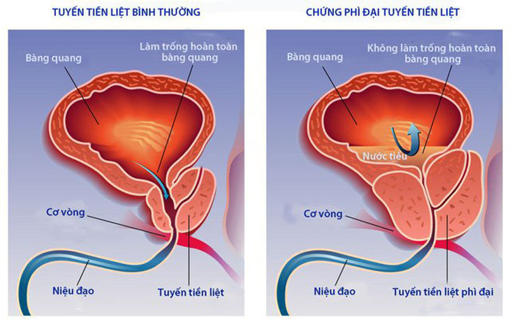 Phì đại tiền liệt tuyến: Nguyên nhân, triệu chứng, chẩn đoán và điều trị