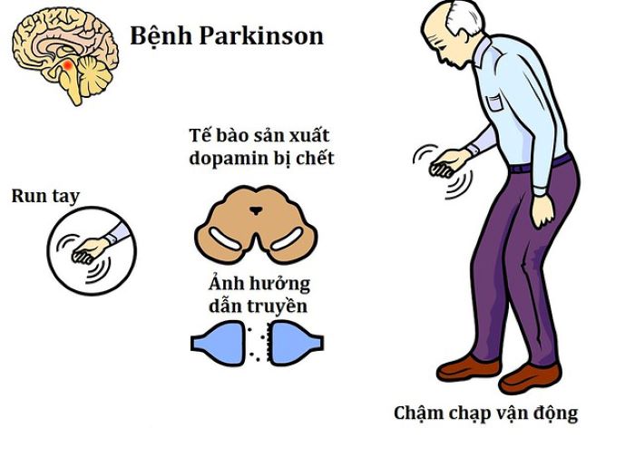 Parkinson: Nguyên nhân, triệu chứng, chẩn đoán và điều trị