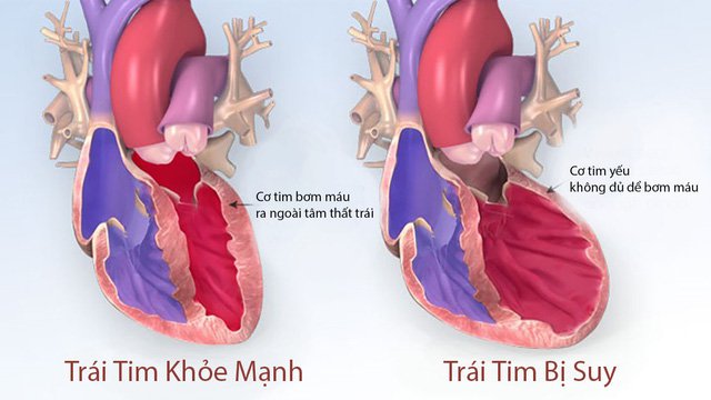 Thuốc giúp cải thiện triệu chứng ở bệnh nhân suy tim