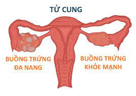 Buồng trứng đa nang. Nguyên nhân, triệu chứng, chẩn đoán và điều trị