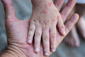 Bệnh Rubella. Nguyên nhân, triệu chứng, chẩn đoán và điều trị