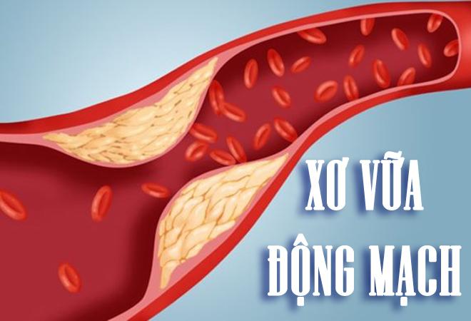 Xơ vữa động mạch não