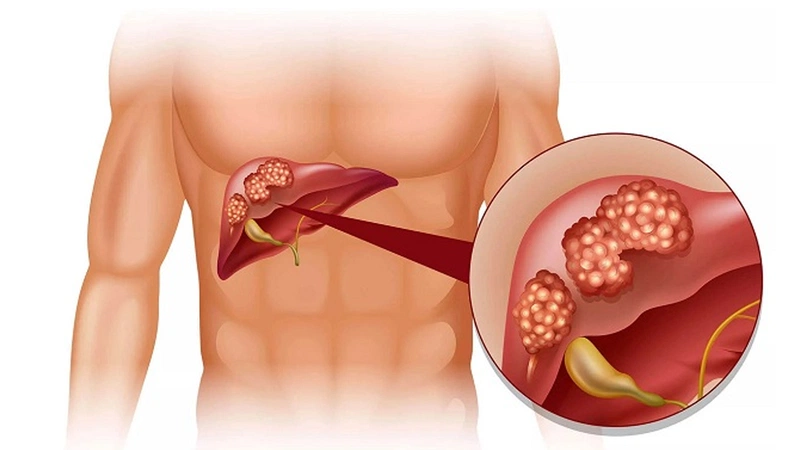 Ung thư gan nguyên phát: Nguyên nhân, triệu chứng, chẩn đoán và điều trị