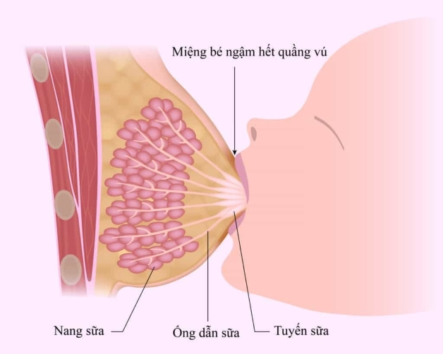 Tắc tia sữa: Nguyên nhân, triệu chứng, chẩn đoán và điều trị