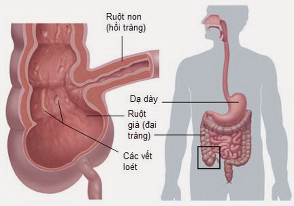 Lao ruột: Nguyên nhân, triệu chứng, chẩn đoán và điều trị