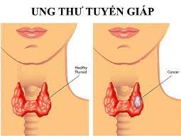 Ung thư tuyến giáp: Nguyên nhân, triệu chứng, chẩn đoán và điều trị