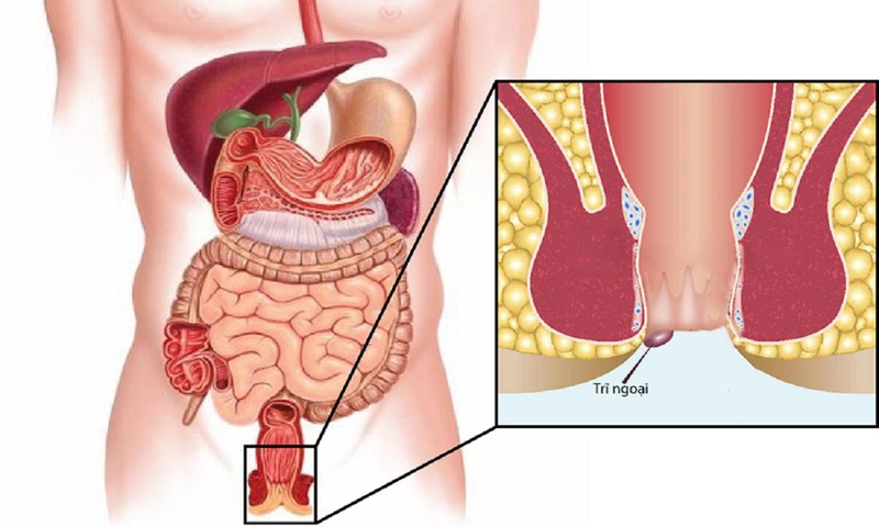 Trĩ ngoại: Nguyên nhân, triệu chứng, chẩn đoán và điều trị