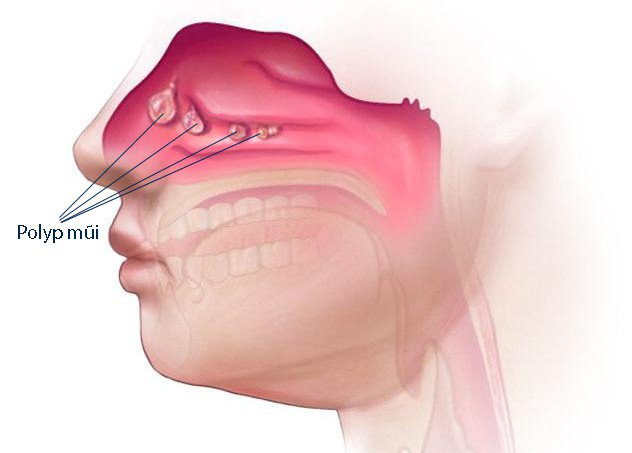 Polyp mũi: Nguyên nhân, triệu chứng, chẩn đoán và điều trị