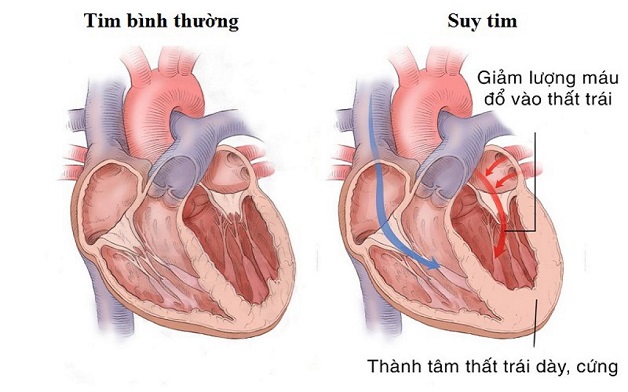 Suy tim cấp: Nguyên nhân, triệu chứng, chẩn đoán và điều trị