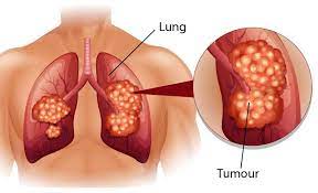 Ung thư phế quản phổi nguyên phát: Nguyên nhân, triệu chứng, chẩn đoán và điều trị