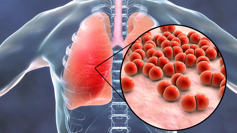 Nhiễm nấm Histoplasma (vi nấm histoplasma): Nguyên nhân, triệu chứng, chẩn đoán và điều trị