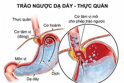 Trào ngược dạ dày thực quản: Nguyên nhân, triệu chứng, chẩn đoán và điều trị