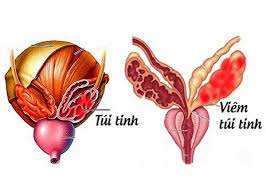 Viêm túi tinh: Nguyên nhân, triệu chứng, chẩn đoán và điều trị